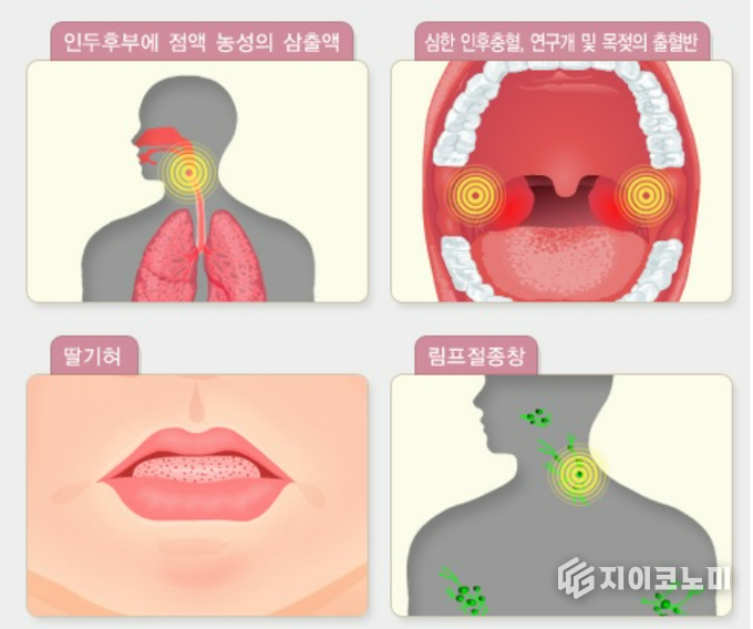 성홍열 증상 이미지. 질병관리청 제공